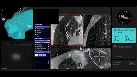 Shape-sensing robotic bronchoscopy and mobile cone beam CIOS workflow