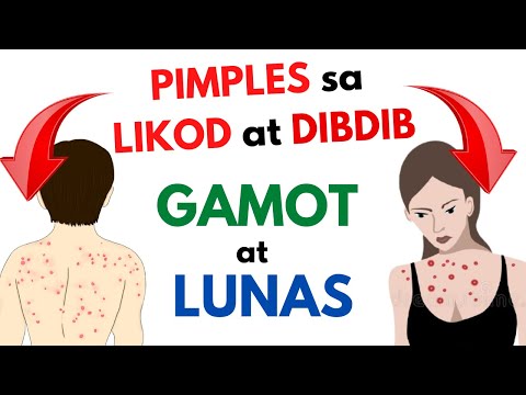 Video: Paano Magagamot ang Acne Sa panahon ng Pagbubuntis: 14 Mga Hakbang (na may Mga Larawan)