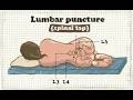 spinal puncture; Lumbar puncture LP,  medical procedure a needle is inserted into lower back