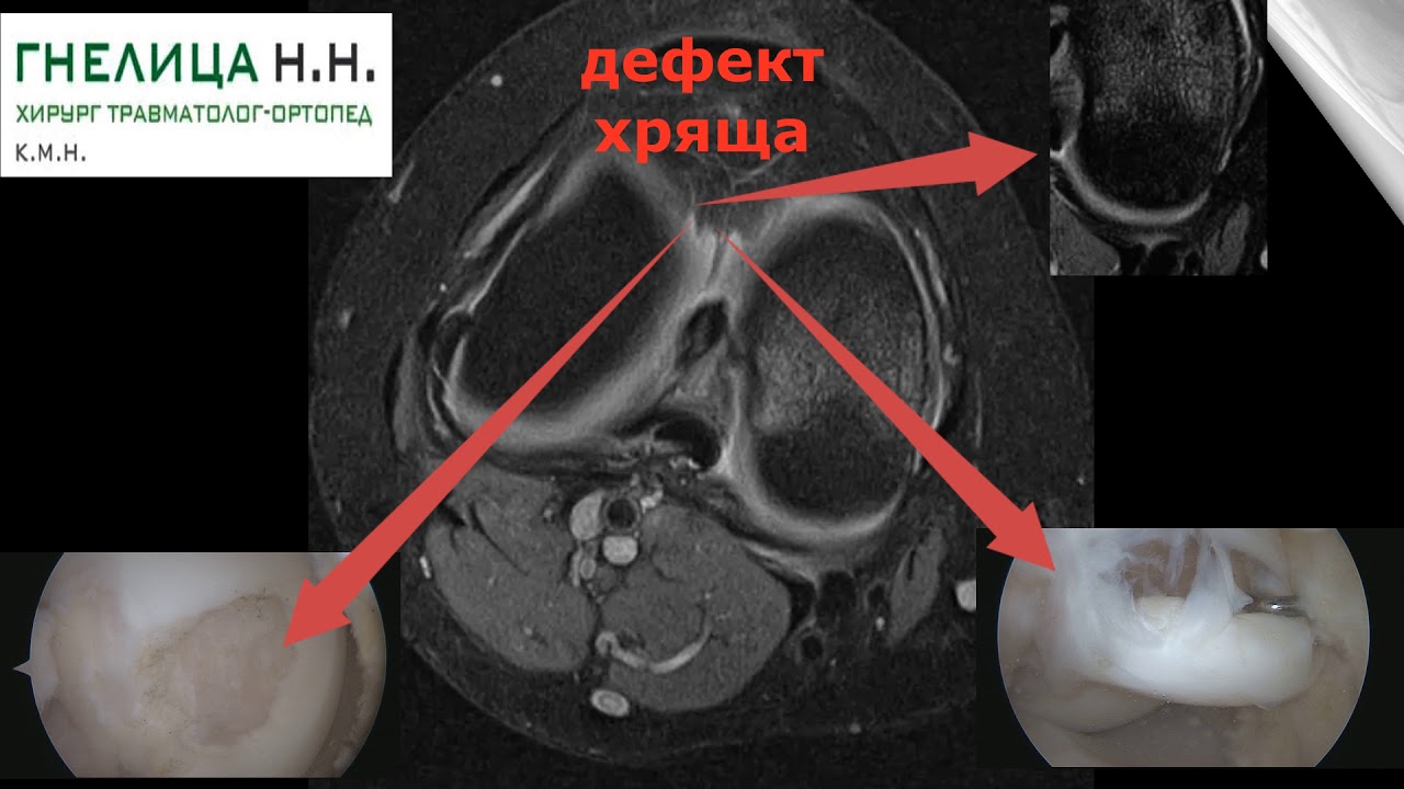 Артроскопия коленного сустава, хондропластика мозаичная по поводу болезни Кенига, хирург Н.Н.Гнелица