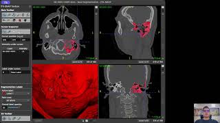 Segmentation of mastoid on CT scan using ITK Snap