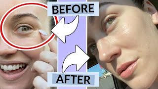 How To Treat Crows Feet, Wrinkles, Fine Lines Without Botox