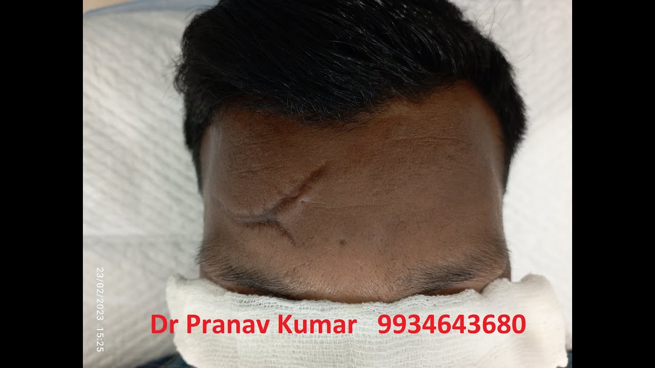 Scar Revision Scar Over Forehead Dr Pranav Kumar Plastic Surgeon Scar Revision Scar Over Forehead Dr Pranav Kumar Plastic Surgeon