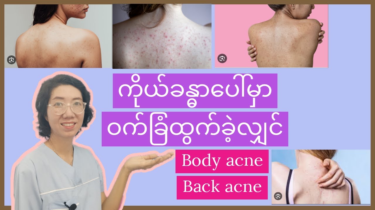 how to get rid of body acne ပျောက်စေချင်သောကျောပေါ်မှဝက်ခြံများအကြောင်း
