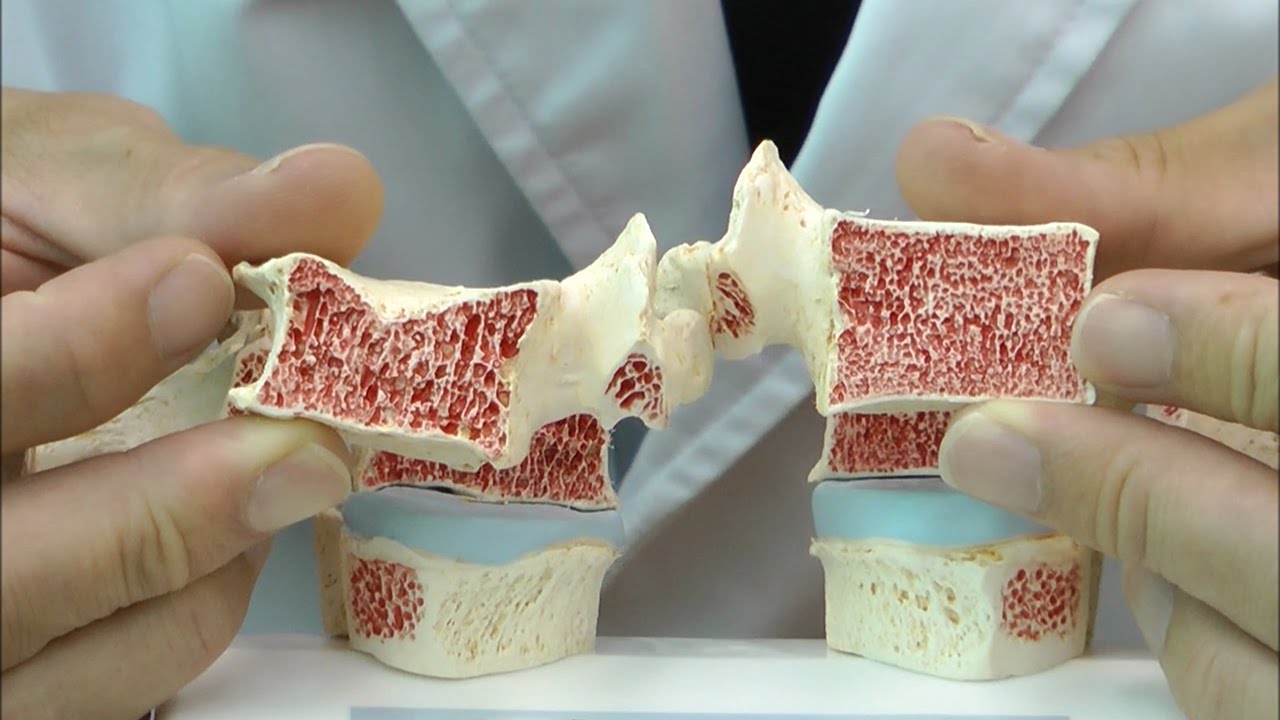 骨粗しょう症と健康な状態を比較できる胸椎模型│A95 - YouTube