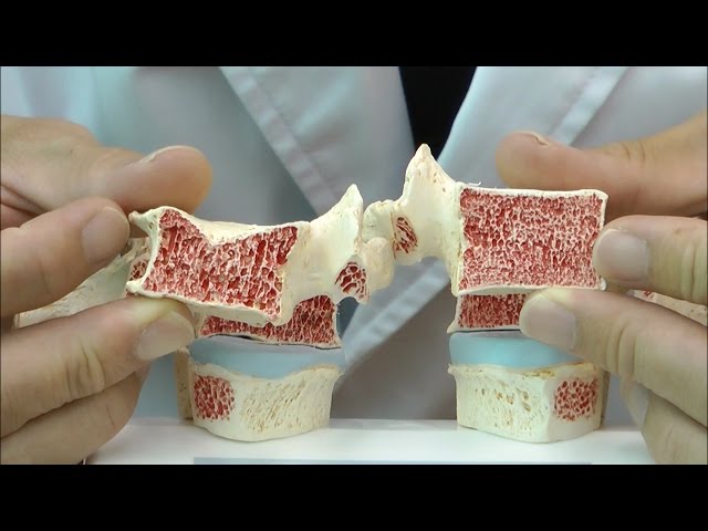 骨粗しょう症と健康な状態を比較できる胸椎模型│A95 - YouTube