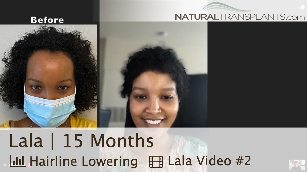 Hair Loss Women - Hair Transplant Surgery Can Reduce Your Forehead | Dr. Kevin Blumenthal (Lala)