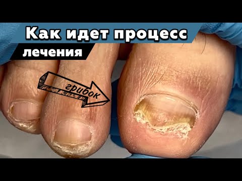 Грибок ногтей. Первый этап в плане лечения 