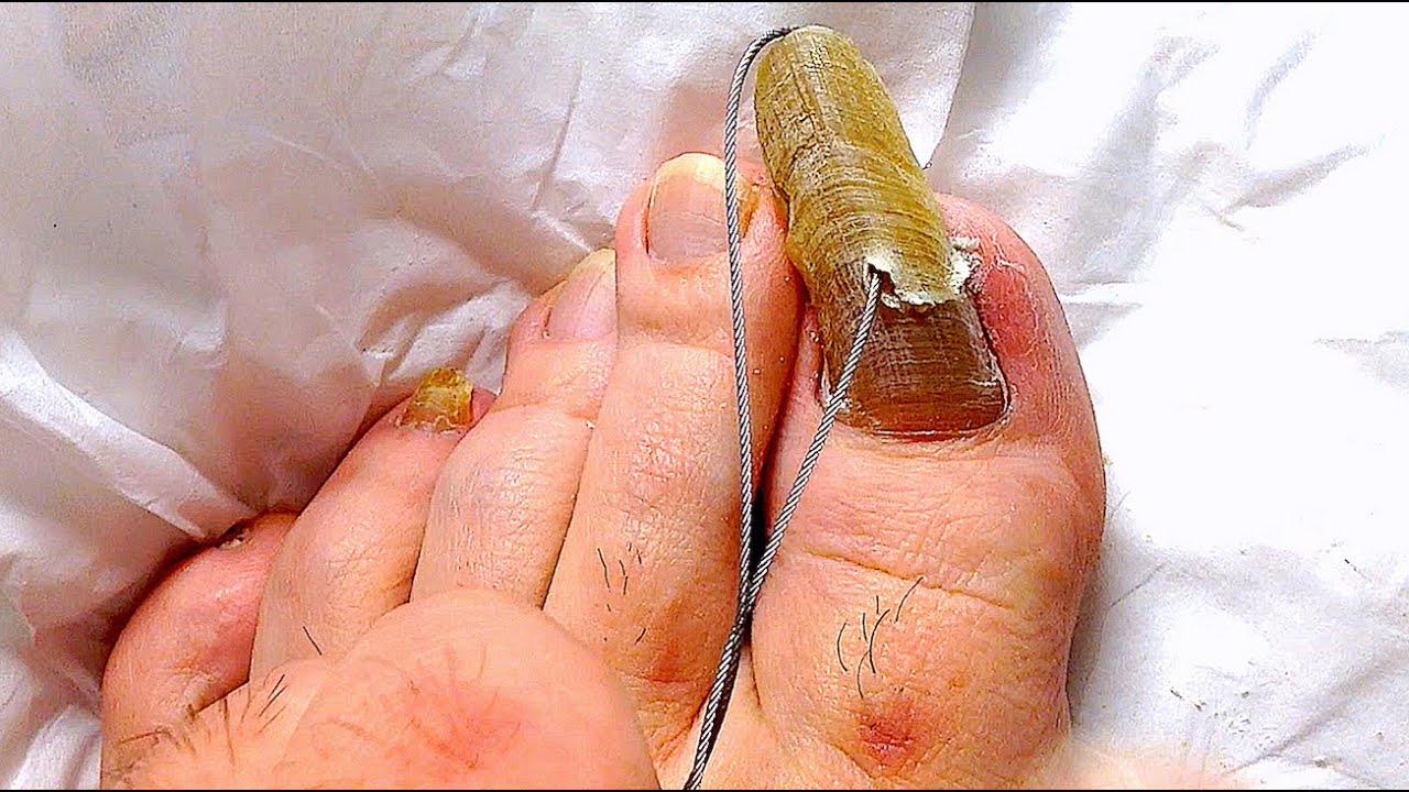 !PODOLOGIA! Cut With Wire! THE THICKEST FUNGAL TOENAIL PART2 Rolo do
