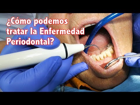 Enfermedad Periodontal II. ¿Cómo podemos tratar la enfermedad periodontal?