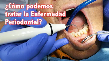 ¿Cómo saber si la periodontitis está avanzada?