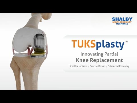 TUKSplasty™: Advanced Knee Surgery for Osteoarthritis Relief | Shalby Hospitals Ahmedabad