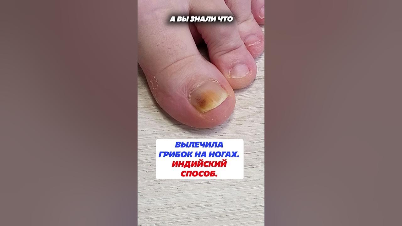 Вылечила грибок на ногах. Индийский способ. #грибокногтей # ...