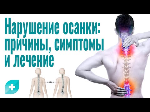 Нарушение осанки: причины, симптомы и лечение