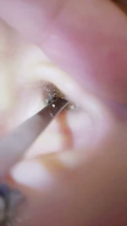 Gentle ear wax removal helps you relax comfortably #relax #massage #asmr #spatreatment