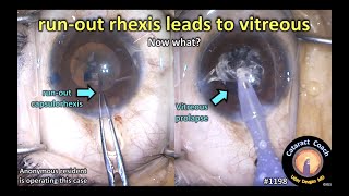 CataractCoach 1198: run-out capsulorhexis leads to vitreous loss