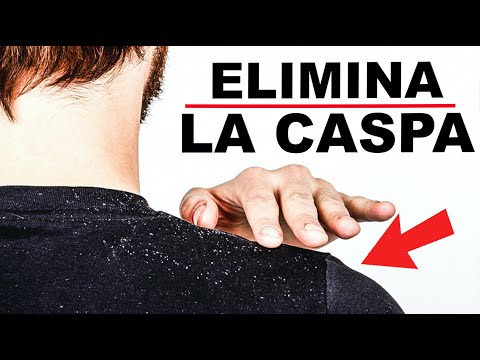 Video: Cómo Deshacerse De La Caspa Rápidamente Para Hombres