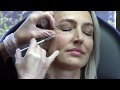 Botox Around the Eyes ~ Prevent Crows Feet