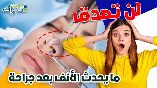 عملية تجميل الانف, جراحة التجميل الانف ,الجراحة التجميلية للأنف