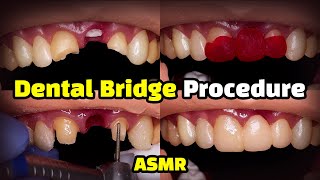 Dental Bridge Procedure