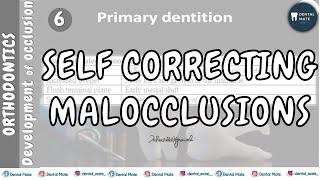 Self correcting malocclusions | Transient Malocclusion | Dr Paridhi Agrawal