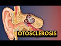 OTOSCLEROSIS, Causes, Signs and Symptoms. Diagnosis and Treatment.