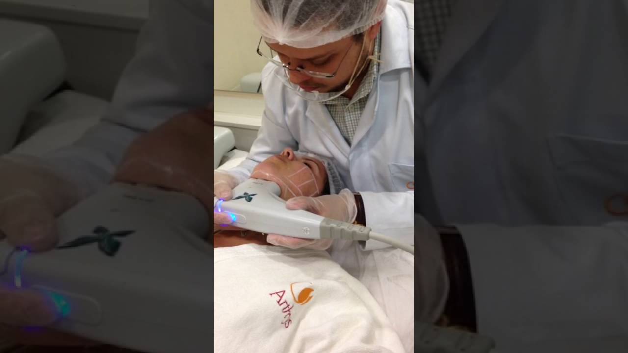 Vithara -  Ultrassom microfocado para papada