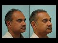 Deepak's Hairline, Central Density, & Temple Hair Transplant Testimonial in Dallas