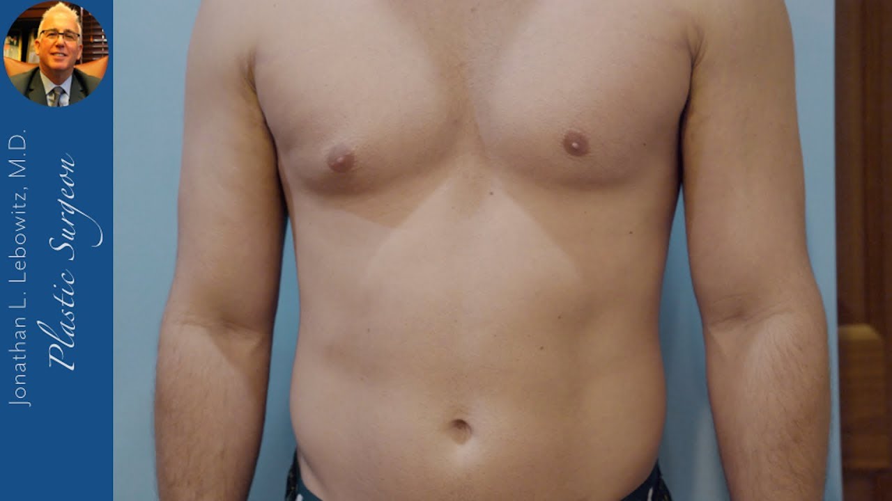 One Side ProHormone 💉 (UniLateral) Surgery, Long Island