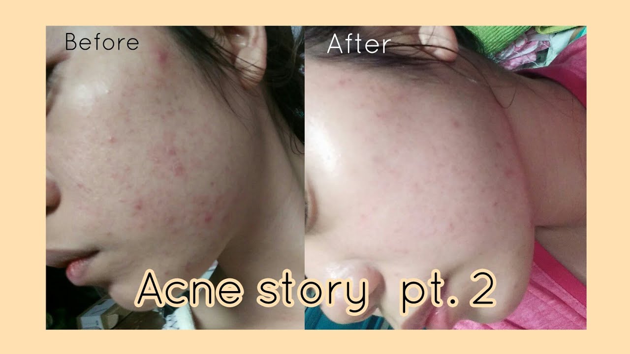 My Acne Story pt.2 + 4 products that I used - YouTube