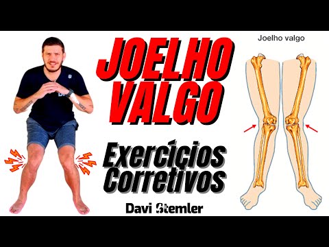 JOELHO VALGO - EXERCÍCIOS CORRETIVOS (PREVENÇÃO DE LESÃO DE LCA) - Davi Stemler