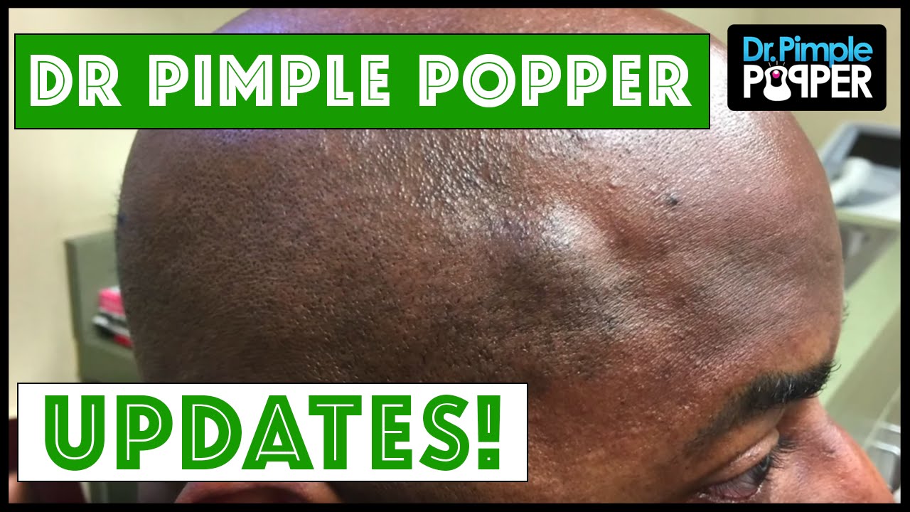 Dr Pimple Popper UPDATES!  How do these bumps look now? - To see the original videos, please click on the links below: