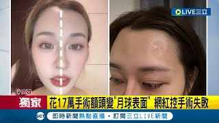 #三立獨家 想變美卻害皮膚變月球表面...網紅愛美花17萬填脂付慘痛代價 額頭鈣化更出現腫塊 凹凸不平打消脂針更慘|記者 陳亭汝 江文賢 黃智忠|【LIVE大現場】20230313|三立新聞台