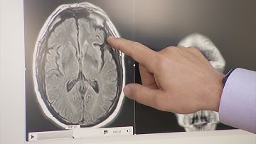 Mild Cognitive Impairment | Eyewitness News