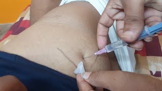 IM इंजेक्शन देने का सही तरीका | Easy steps to give Intramuscular injection | im injection technique
