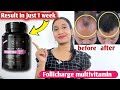 follicharge Biotin 10000mcg Review After use of 2 month Result|2024