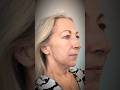 Lower face contouring with dermal fillers ✨ #jowls #jawline #jawlinefiller