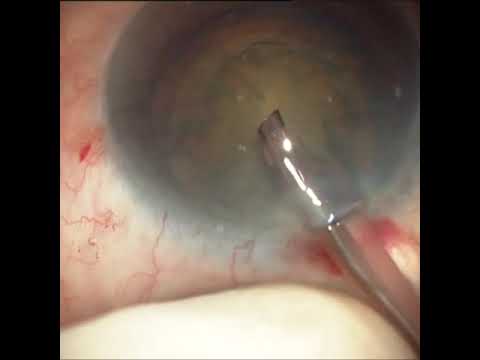 posterior subcapsular cataract , cataracte sous capsulaire postérieure