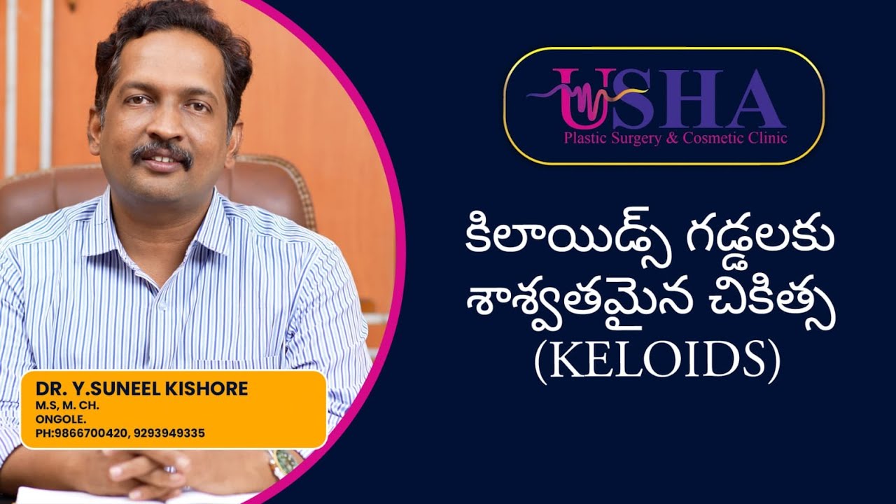 కిలాయిడ్స్ గడ్డలకు శాశ్వతమైన చికిత్స (KELOIDS)