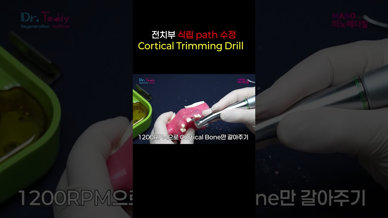 전치부 식립 path 수정Cortical Trimming Drill 