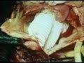 Хирургия аневризмы восходящей аорты, 1988