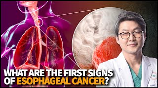 What is Esophageal Cancer? What are the first signs of Esophageal Cancer?