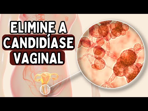 COMO ACABAR COM CANDIDÍASE, HERPES E CORRIMENTO | Dr Dayan Siebra