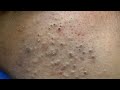 ASMR Fast Blackhead Removal &amp; Facial Care Routine With Dermatologist 👨‍⚕️[DERMATOLOGY ASMR]