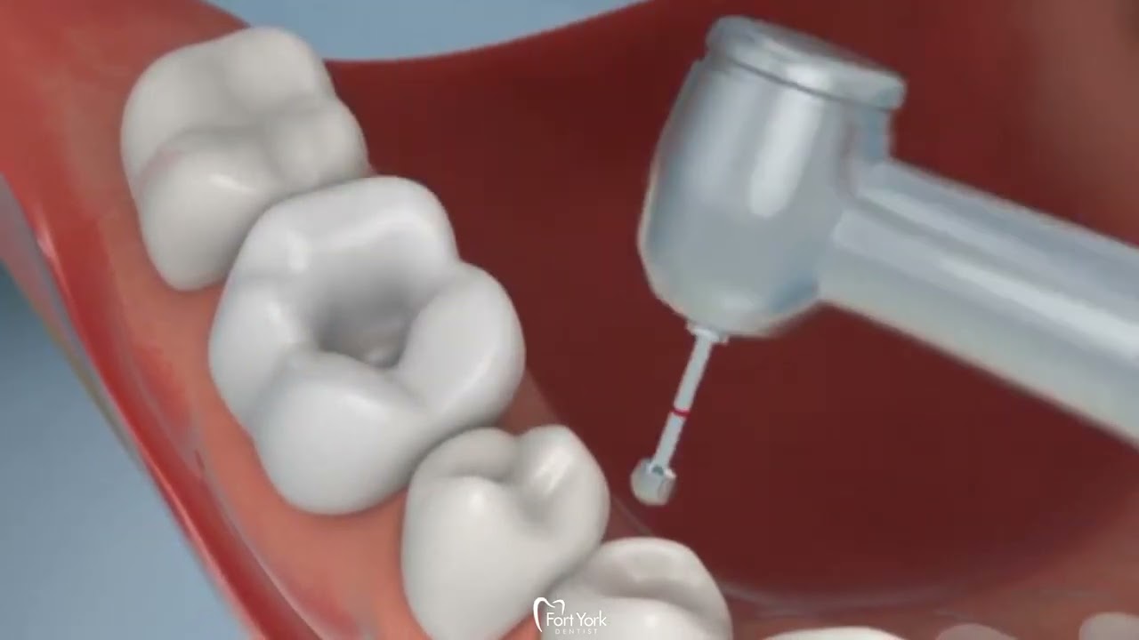 Dental filling