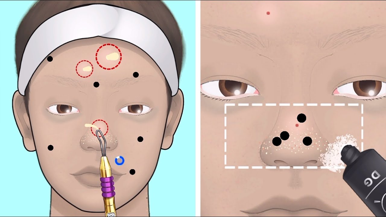 ASMR Blackhead, acne, pimple popping removal animation YouTube