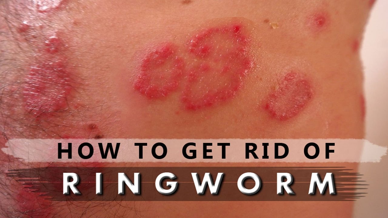 how to get rid of ringworm cream