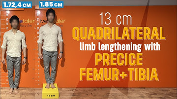 14 CM  QUADRILATERAL LIMB LENGTHENING WITH PRECICE FEMUR+TIBIA