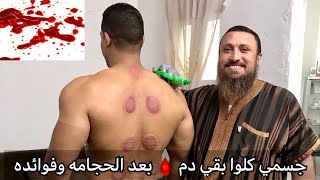 فوائد الحجامه للضغف الجنسيه وللتخسيس للرجال والنساء ،