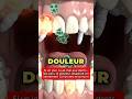 Ref:Amv0a5WKLSc Si un jour tu as mal aux dents, fais ceci : la douleur dispara�t en seulement 5 minutes maximum.